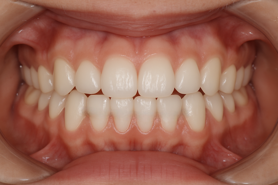 Spark Aligners TruGEN ortodoncia Sevilla