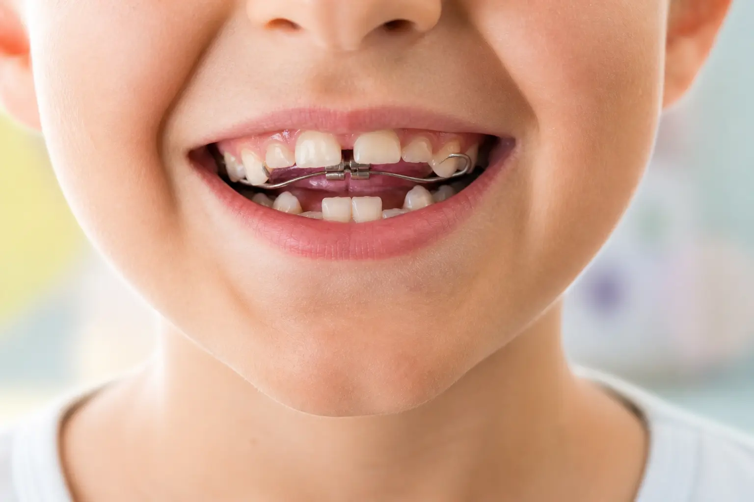 Limpieza dental con brackets, cepillo interdental sobre ortodoncia metálica